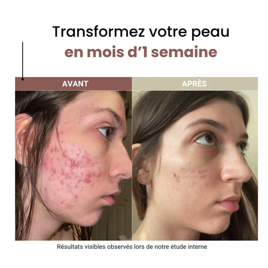 Cure Clean – Des résultats visibles en 7 jours